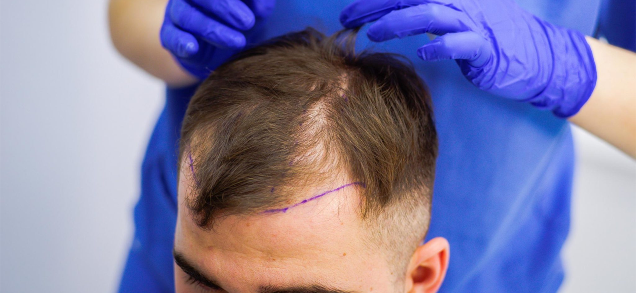 https://www.highnessclinics.ae/wp-content/uploads/2023/12/HAIR-TRANSPLANT-2-1.png