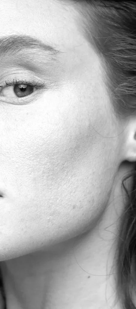 Buccal Fat Removal Dubai