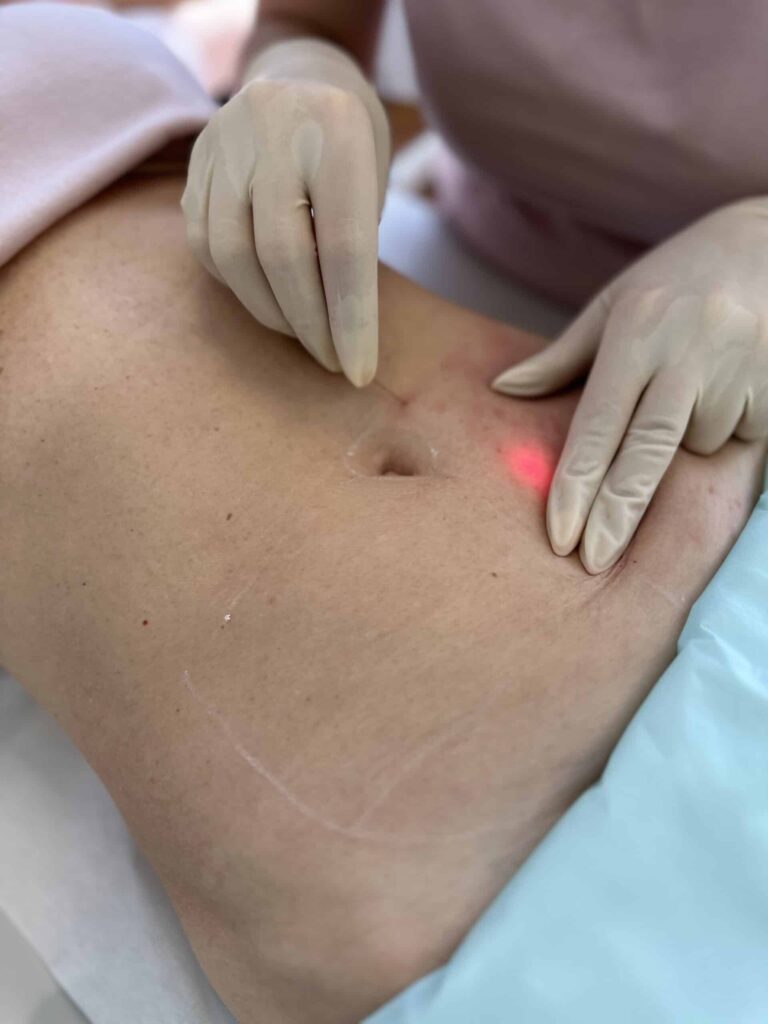 endolift in dubai treatment