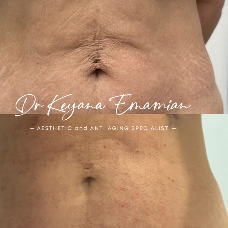 Endolift done in Abs