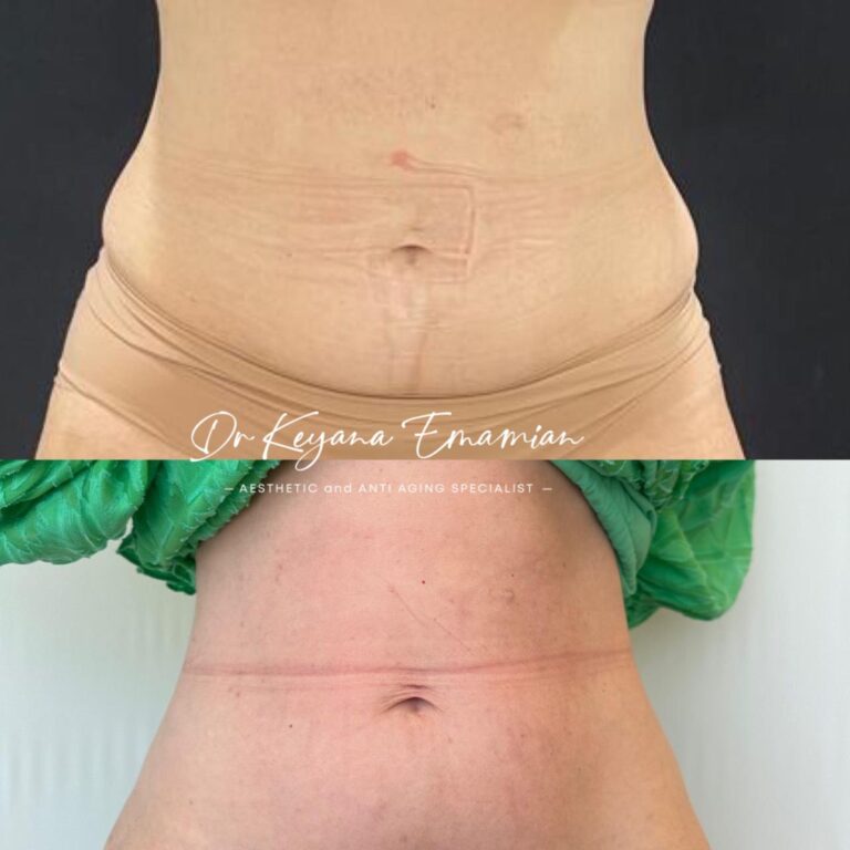 Endolift dubai treatment done in abdomen