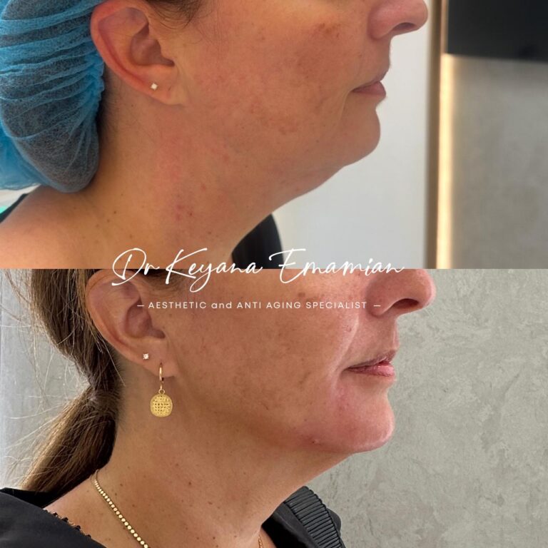 Endolift in dubai treatment done in Face Jawline