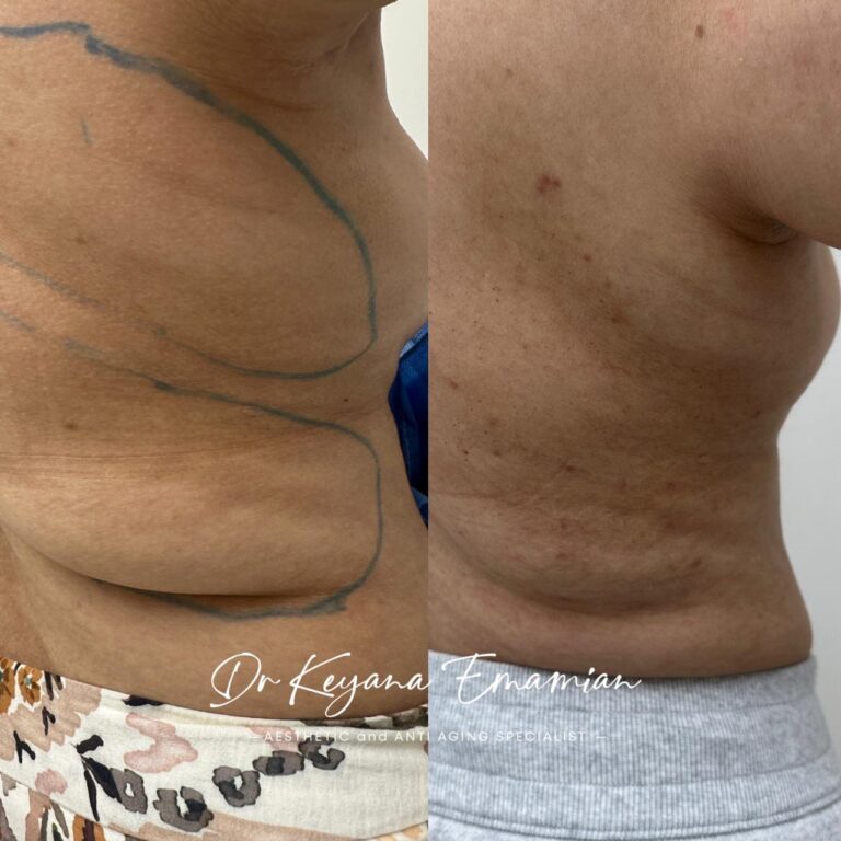 Endolift in dubai done on the backside of body
