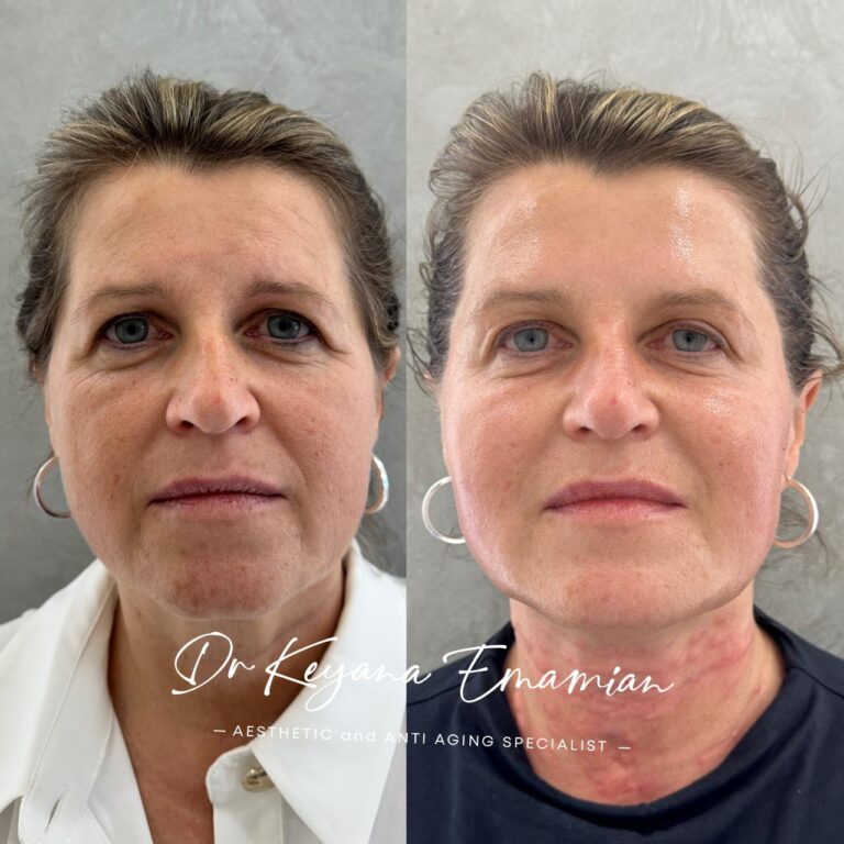 Endolift in dubai done in Face woman