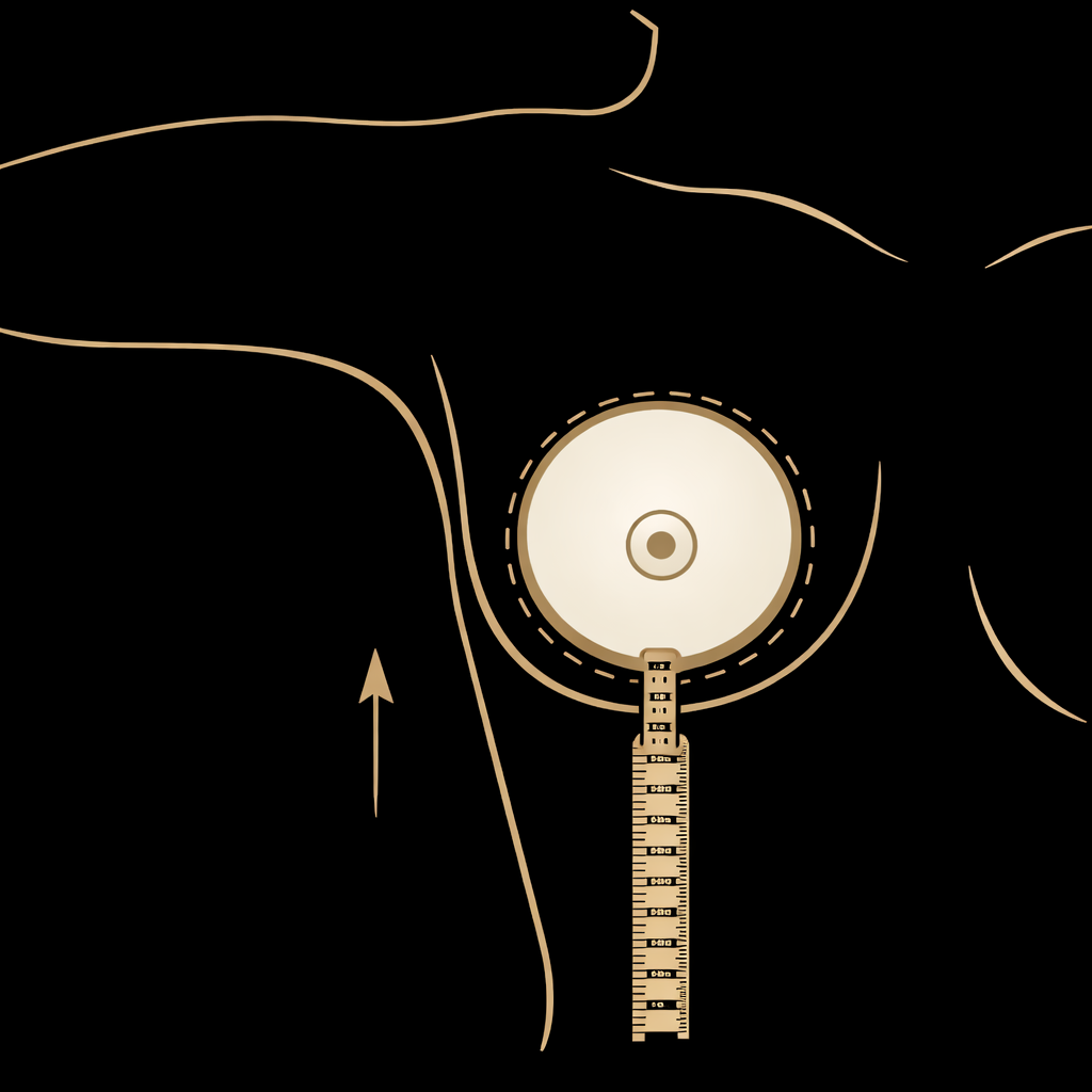 Preserve Breast Augmentation Procedure 2