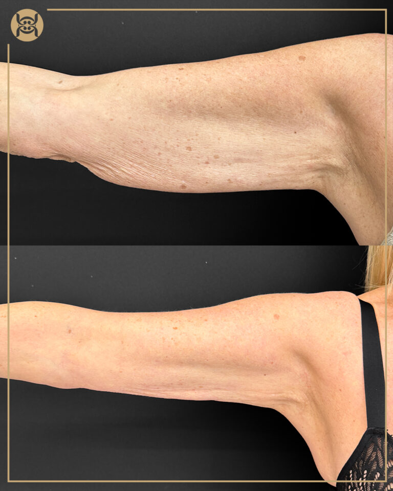 Endolift in dubai done on arms of woman