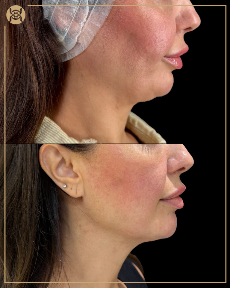 Endolift in dubai done on right side of face