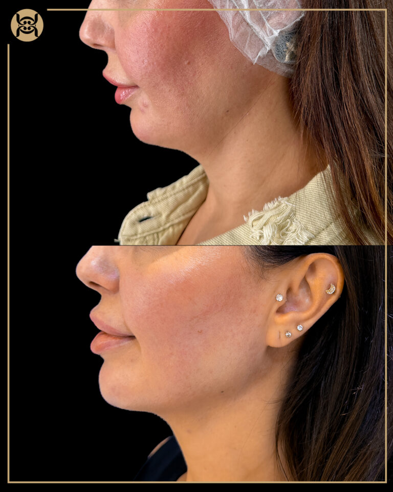 Endolift in Dubai done on woman's face