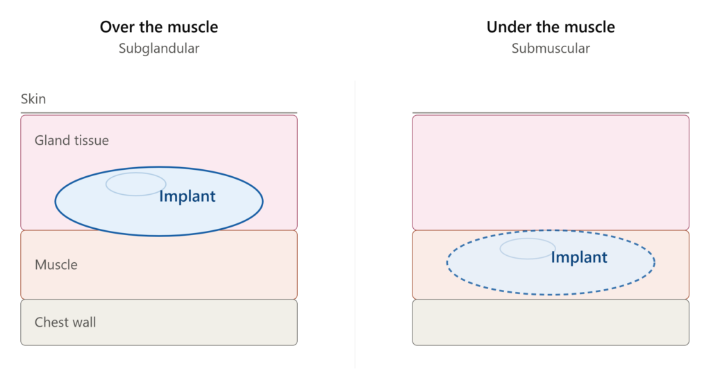 Breast augmentation in Dubai — diagram comparing over-the-muscle and under-the-muscle implant placement